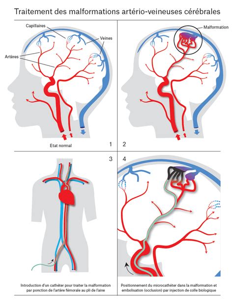 malformation artério veineuse cérébrale pdf.